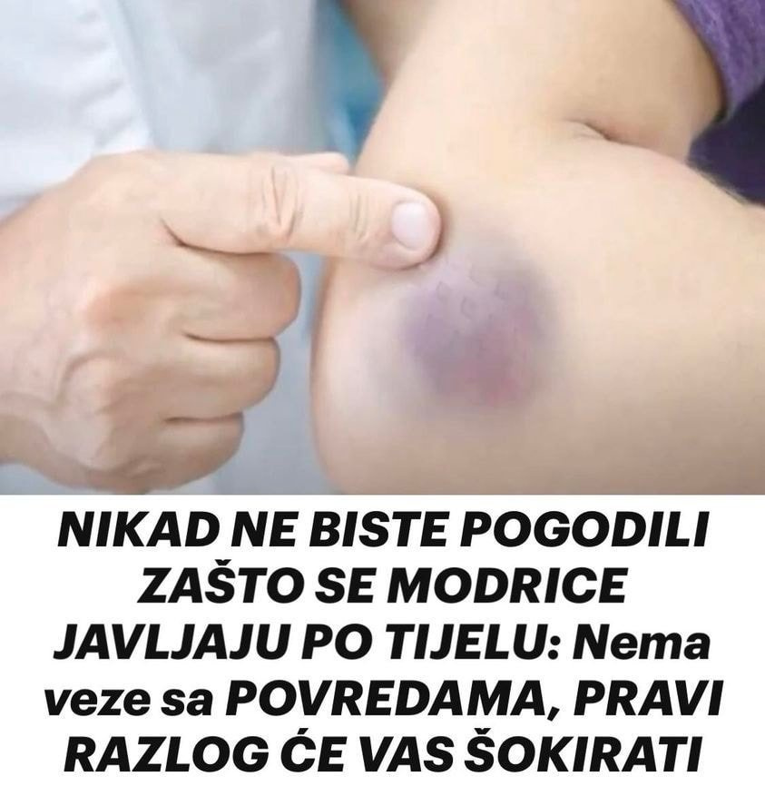 Modrice su čest fenomen koji